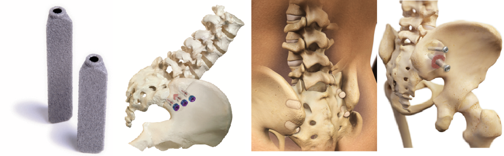 Sacroiliac joint fusion devices from left to right: SI-Bone iFuse, Globus Medical SI-Lok, NuTech SI-Fix, Zyga SImmetry