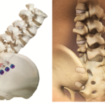 Sacroiliac joint fusion devices