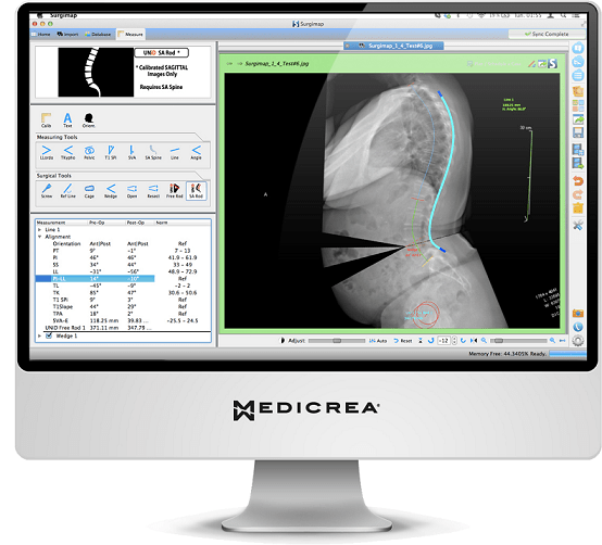 Medicrea UNiD planning software (Surgimap)