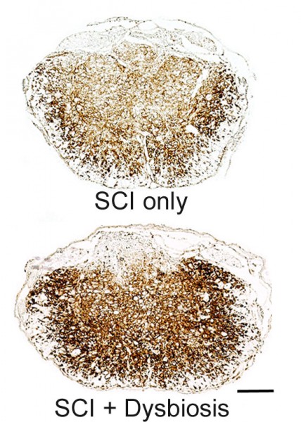 Disrupting the gut microbiome with antibiotics before spinal cord injury (bottom) increases the number of inflammatory cells (brown) in the damaged region of the spine. (Kigerl et al, 2016) 