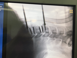 Fluoroscopy image of AxioMed's Freedom disc successfully implanted
