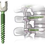 DePuy Synthes Viper and Expedium