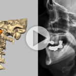 planning-postop 3D vertebrae2