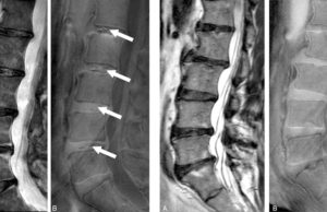 MRI of the lumbar spine of two subjects