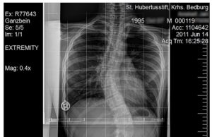 Scoliosis in a 15-year-old