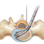 The Concorde Clear minimally invasive discectomy device
