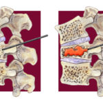 vertebroplasty-640×400