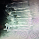 6 month X-ray Pt3