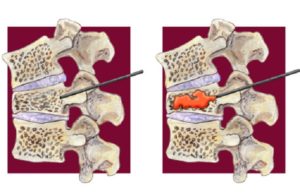 National Osteoporosis Foundation supports new evidence-based vertebral  compression fracture care pathway