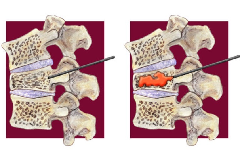 Resolving Compression Fractures with Kyphoplasty