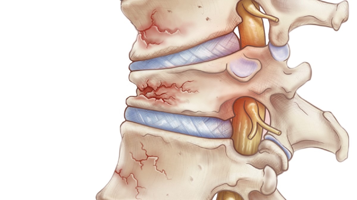 Vertebral Compression Fractures (VCF) - Treatment by Spine