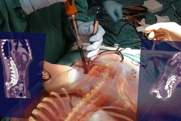 3D augmented reality surgical navigation system achieves FDA approval for  precision spine surgery - Spinal News International